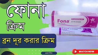 ব্রন দূর করার Fona Cream ফোনা ক্রিম ব্যবহারের নিয়ম এর পার্শ্বপ্রতিক্রিয়া EMADICINE [upl. by Spragens970]