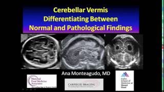 AIUM Webinar Cerebellar Vermis [upl. by Anawaj]