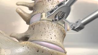 STALIF M™ MIDLINE II Surgical Technique Animation  Anterior Lumbar Interbody Fusion [upl. by Calderon]