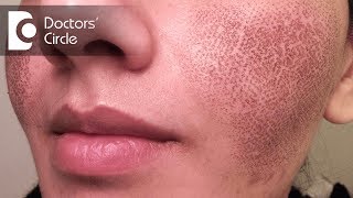 How to treat dark spots  Melasma  Causes amp treatment  Dermatologist  Dr Aanchal Panth [upl. by Bogart481]