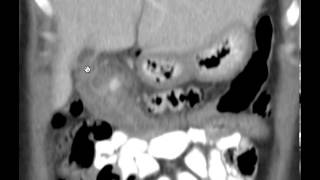 CT Abdomen Diverticulitis Discussion by Radiologist [upl. by Sukhum337]